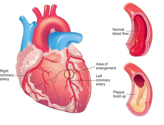 Coronary Heart Disease Coronary Heart Disease (CHD) - atherosclerosis of the coronary arteries, which can result in a heart attack 19 Coronary Heart Disease CHD is the leading form of all