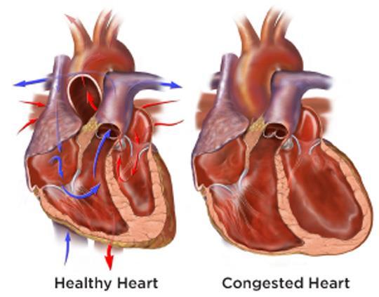 Congestive Heart Failure Usually follows a severe heart attack Heart s pumping power is weaker than normal