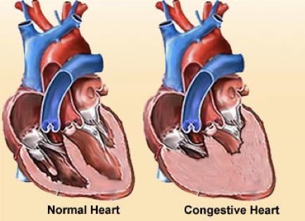 compensate) Eventually the heart muscle weakens Person with this condition experiences difficulty breathing,