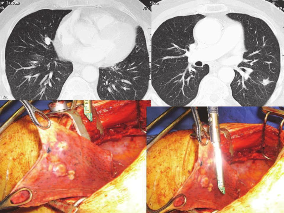Surgical Treatment of Pulmonary Metastases from Melanoma: Emerging Options 207 Fig. 1.