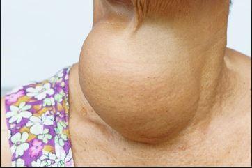 Goiter Different thyroid disorders as well as a
