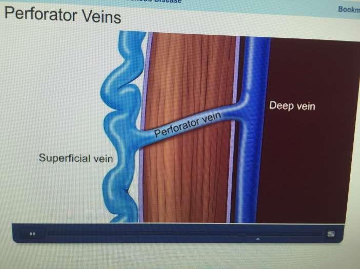 DILATED SUPERFICIAL VEINS