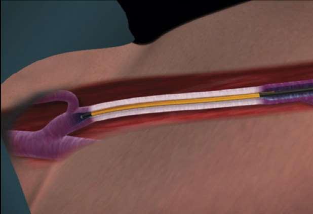 RADIOFREQUENCY ABLATION (RFA) Outpatient procedure approximately 60 min.