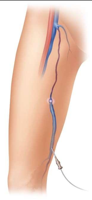 ENDOVENOUS LASER ABLATION Outpatient procedure approximately 60 min long Only local