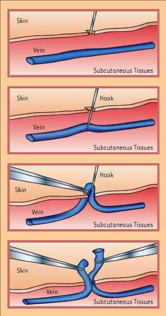 PHLEBECTOMY Very esthetic method of removing varicose veins Usually