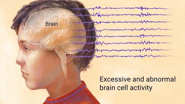 Epilepsy Disorder where nerve cell activity in the brain is disturbed, causing seizures.