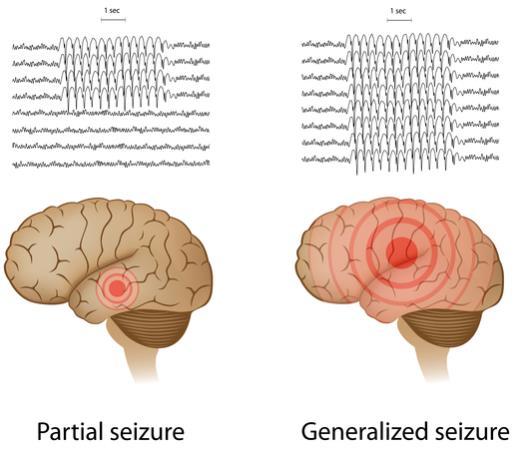Epilepsy Epilepsy is a spectrum condition with a wide range of seizure types: Focal - specific place in the brain Without loss of consciousness and with impaired awareness Generalized - all over the