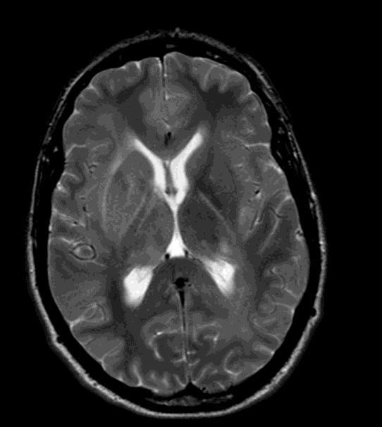 This is the case of a MSM variably complaint on ART presents with headache and focal neurology including cognitive slowing. His CSF investigations showed.