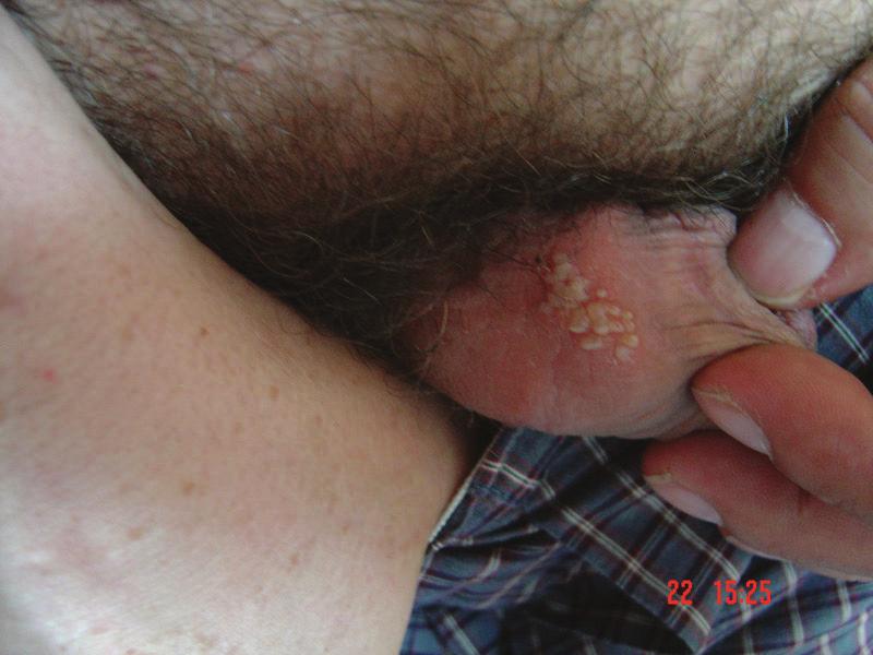 Genital Herpes http://dx.doi.org/10.5772/intechopen.70105 55 varying sizes. Painful and inflammatory vulvar edema is present in women.
