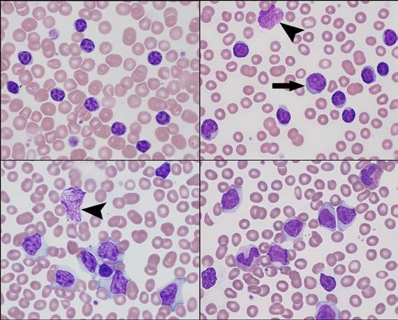 Blood Cell Identification: 2011-B Mailing: Chronic Lymphocytic Leukemia/Small Lymphocytic Lymphoma (CLL/SLL) Please Note: To view the Figures and Images contained within this education activity in