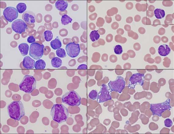 Blood Cell Identification: 2011-B Mailing: Chronic Lymphocytic Leukemia/Small Lymphocytic Lymphoma (CLL/SLL) Table 3. Cytogenetic Findings in Chronic Lymphocytic Leukemia (CLL).