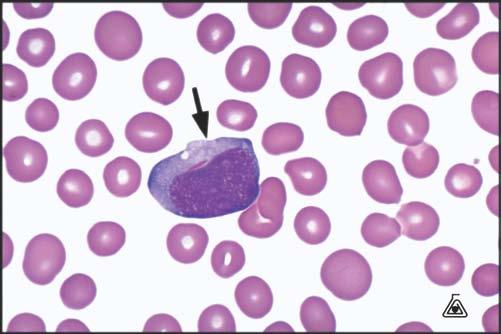 Figure 1. Myeloblasts with Auer Rods. Figure 2. Flow Cytometry in a Typical Case of Acute Myeloid Leukemia.
