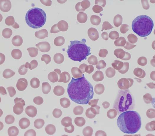 Myeloproliferative Neoplasms Myeloproliferative neoplasms are clonal hematopoietic stem cell disorders characterized by proliferation of one or more of the myeloid lineages (granulocytic, erythroid,