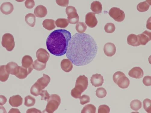 In the early stages there is often trilineage proliferation (panmyelosis) and the diagnosis may be difficult to distinguish from other myeloproliferative neoplasms.