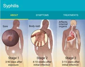 Syphilis Large nodules or gummas are features of tertiary syphilis (late untreated syphilis) whereas flat papulosquamous