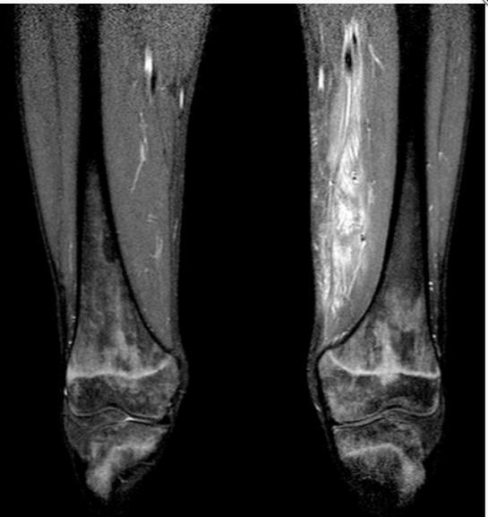 Pyomyositis inner thigh in young patients with severe aplastic anemia (E.coli) http://www.elsevier.