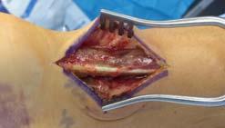 SURGERY (VS NON-OP TX) 3X LOWER RE-RUPTURE RATE RISK OF WOUND COMPLICATIONS QUICKER