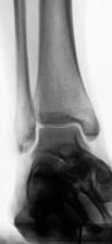 DISTAL TIBIA/FIBULA/TALUS FORM ANKLE MORTISE ( ROOF ) SOME