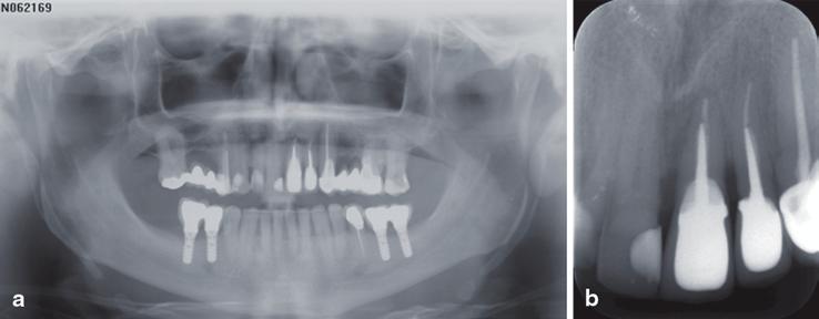 Fig. 9 Intraoral photo 7 years after orthodontic treatment. a e frontal, lateral and occlusal photos Fig.