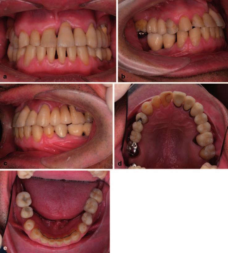 orthodontic mandibular incisor retroinclination.