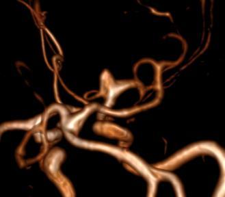 prevention of vasospasm with nimodipine and endovascular coiling or surgical clipping of culprit aneurysm ISAT Trial