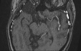 Symptomatic cerebral hyperperfusion, although transient