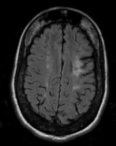 The type of strokes we see in adults Cerebral infarction is associated largely with occlusion or