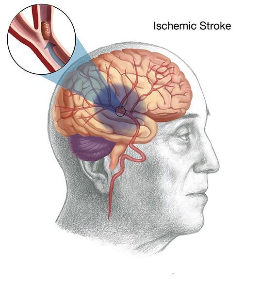 Q1 What percentage of strokes are due to ischemic causes? A.95% B.88% C.50% D.