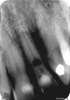 Case Study A healthy 65 year-old male presented to the surgery with the chief complaint of a loose front tooth which was uncomfortable upon chewing and pressure.