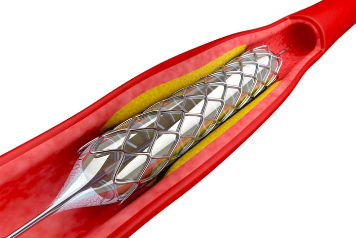 Acute Ischemic Stroke Treatment Surgical treatments Clot removal from the artery using