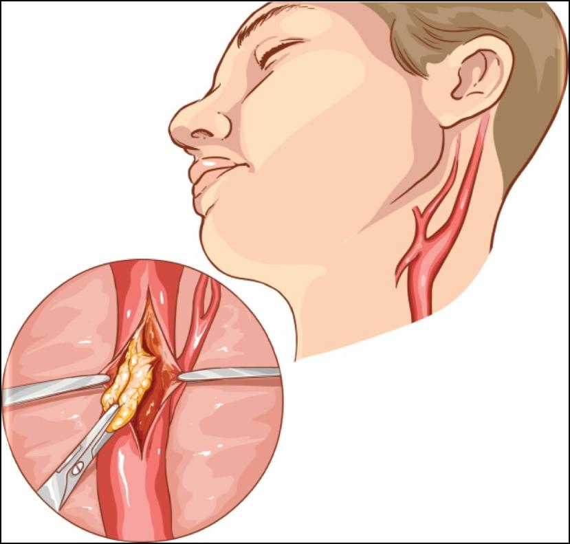 Carotid Artery Disease Narrowing of the carotid artery >70% blockage meets