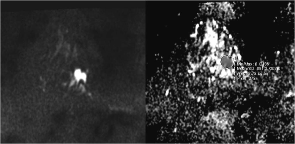 Fig. 2: DWI and ADC map of the same lesion on Figure 1, invasive