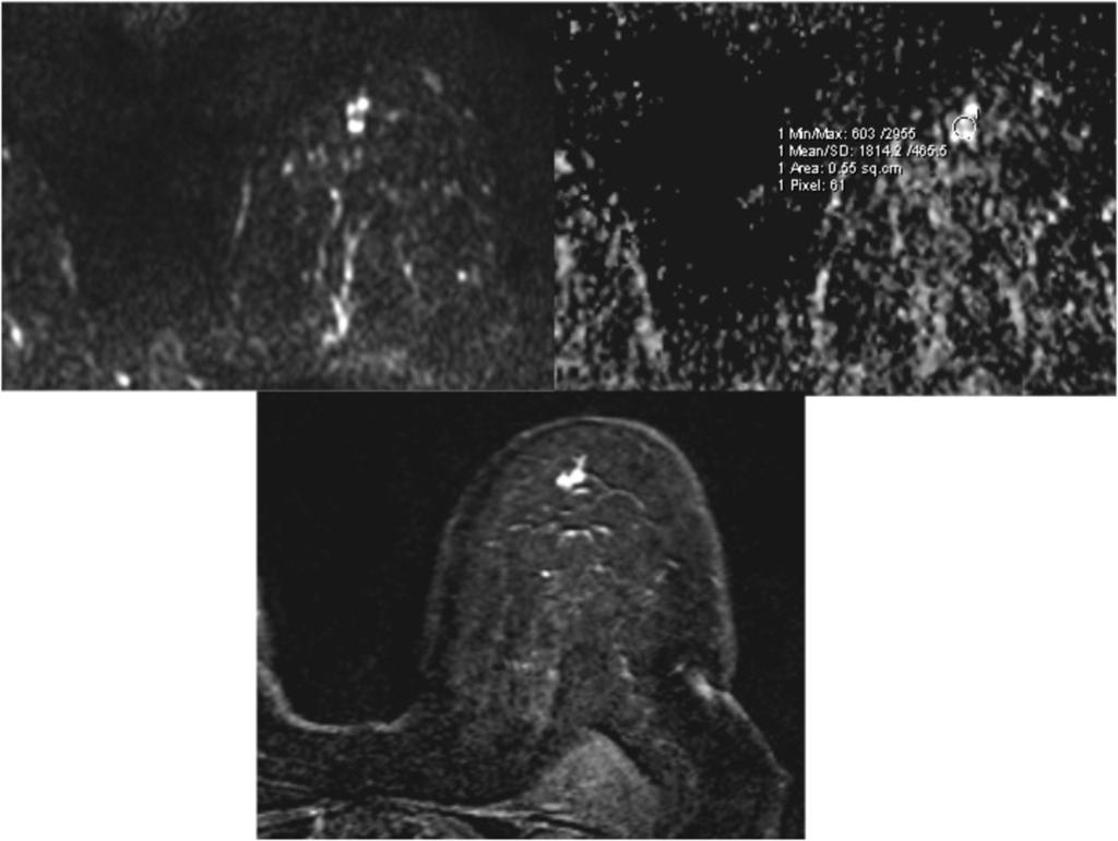 Restricted diffusion of the lesion, high signal intensity on DWI