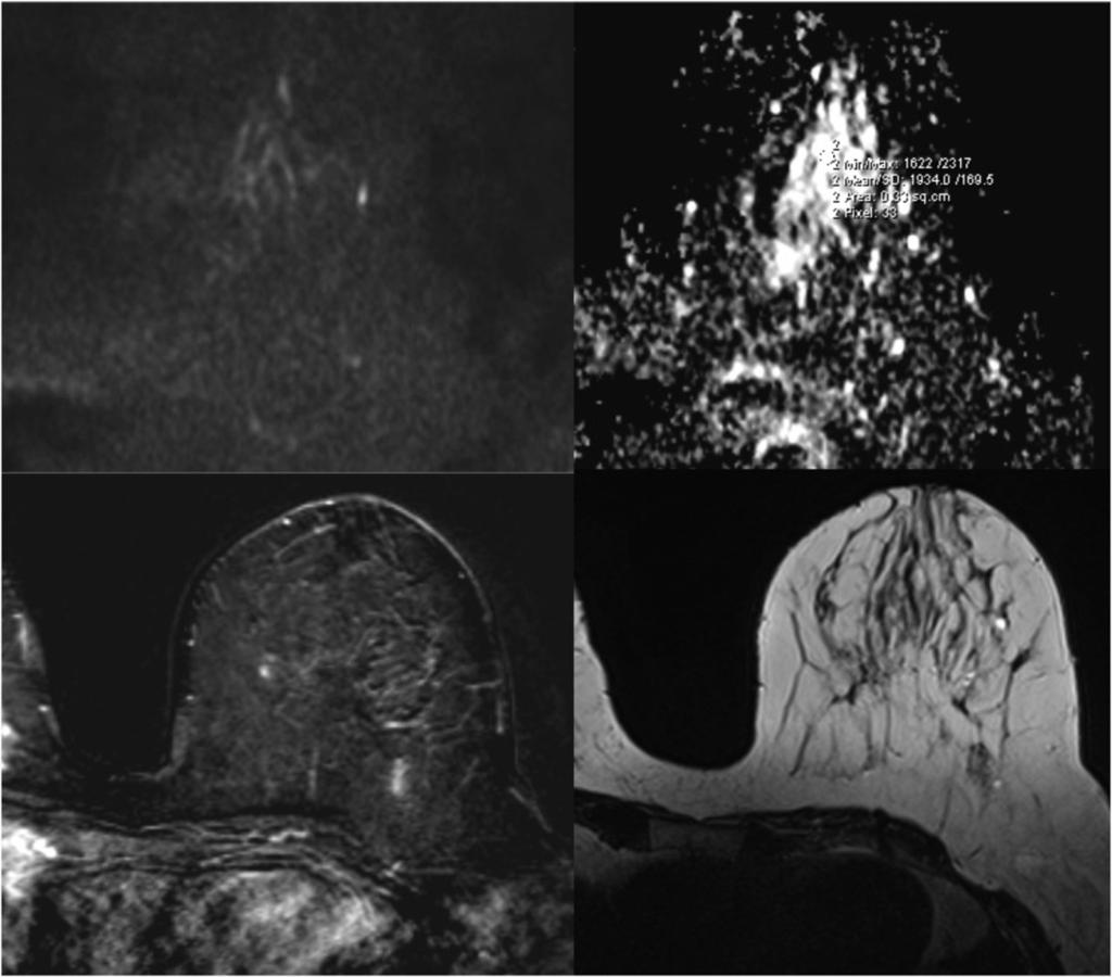 Fig. 3: Benign epithelial hyperplasia. DWI, ADC map and postcontrast T1w images. Enhancing lobulated mass with ADC value 1.814x10-3 for b: 800 s/mm2. Fig.