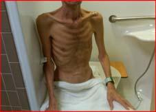 Case Study # 1 Case Study # 1 42 year old Hispanic male admitted to TCID on 10/30/12 Chronic diarrhea, severe malnutrition, having