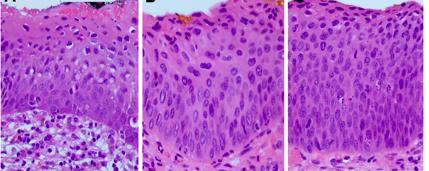 Histology Primer Cervical intraepithelial neoplasia (CIN) Graded based on proportion of epithelium involved CIN 1: indicates active HPV infection; treatment discouraged since spontaneous resolution