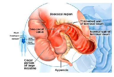 Conditions with similar symptoms Sometimes other conditions can cause abdominal symptoms that appear to be similar to those of Crohn's.