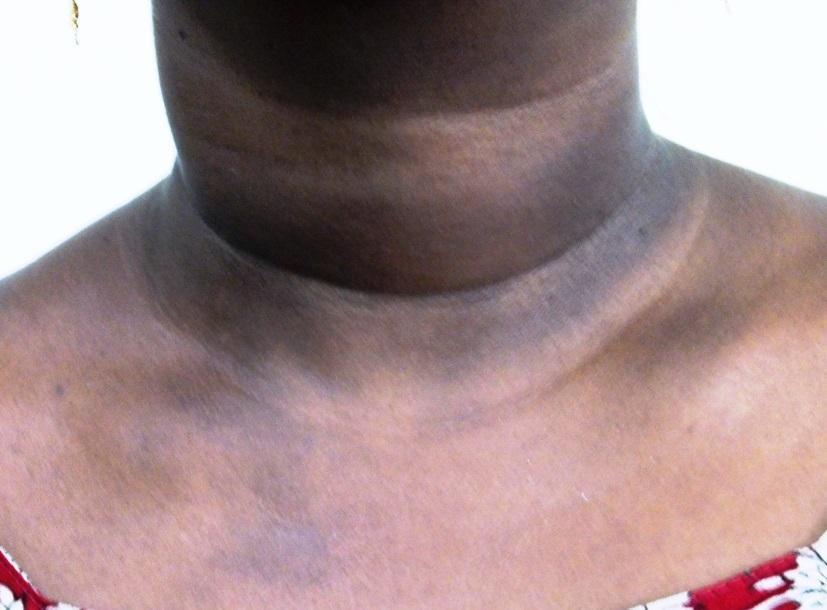 2.4.2 GRADES AND TEXTURES OF AN ON THE NECK Higher grades and textures of acanthosis nigricans were recorded in patients with IR (Tables 2.5 and 2.6).