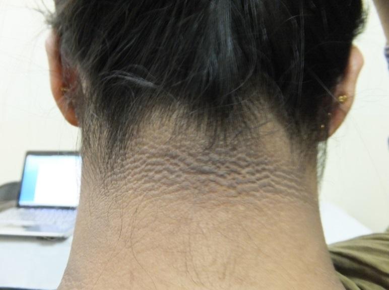 2.4.3. GRADES AND TEXTURE OF ACANTHOSIS NIGRICANS AXILLA Two hundred and eighty-eight subjects had acanthosis nigricans axilla grades I-IV, and 31.25% of those had IR. Fifty-two (17.