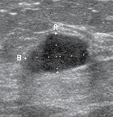 Ultrasound Ultrasound is used to investigate an abnormality detected by mammography or during a physician-performed breast exam.
