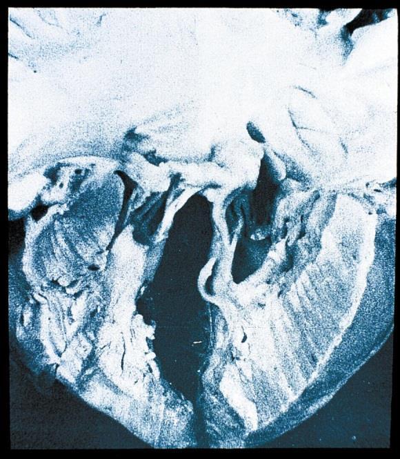 Clinical Presentation to Cardiologist Patients may present with: Left ventricular hypertrophy Mitral