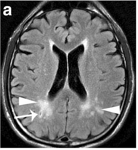 Neurologic Manifestations White matter lesions (WMLS) Single, multiple or confluent hyper-intensities in white matter 1 Small vessel infarctions resulting from GL-3-related endothelial damage might