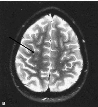 Neurologic Manifestations White matter lesions Arrows