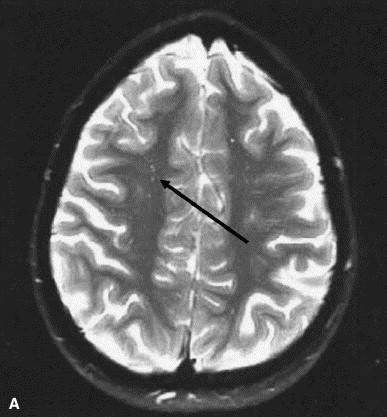 white matter on an MRI of a 11-year-old boy with Fabry