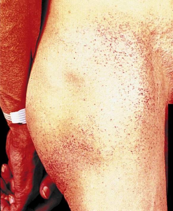 Dermatologic Manifestations Angiokeratomas Bathing trunk distribution
