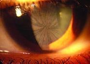 Other Key Clinical Features Cornea verticillata Whorl like corneal opacities (Posterior capsule) usually have a cream-like color Can only be seen during slit lamp exam Detected in approx.