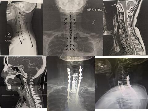 Patient with multilevel metastatic collapse operated in a single stage by C6-T2 corpectomy followed by C3-T6 posterior instrumented fusion.