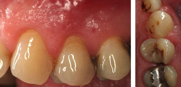 Immediate implants in fresh extraction sockets have been extensively reported in the literature, although data from long-term studies are still limited.