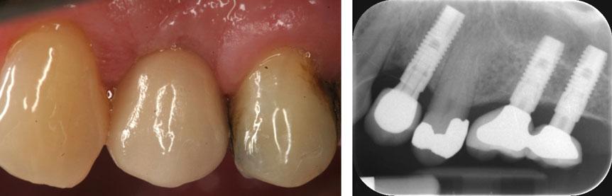 Vignoletti & Sanz A B C Fig. 10. Tooth 2.4. Intrasurgical aspect of the socket: (A) after tooth extraction; (B) after immediate implant placement; and (C) after 4 months, at the re-entry procedure.