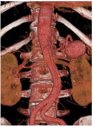 Splenic artery aneurysm SAA represent 60% to 70% of patients diagnosed with VAAs.
